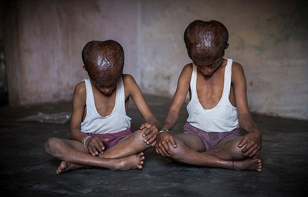 印度兩兄弟身患怪病摸樣異于常人不敢出門