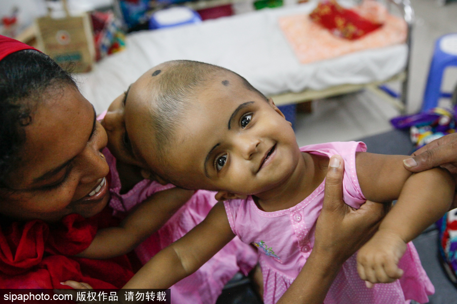 孟加拉國連頭嬰兒 至少到兩歲才能進行手術